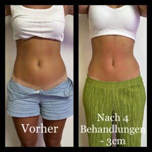 Vorher-Nachher Bodyforming Zürich - Bauchansicht einer Frau vor und nach der Behandlung.